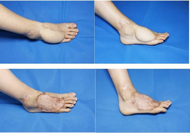 花季少女遇"穿鞋"难题,医生巧手修复令她重获新生